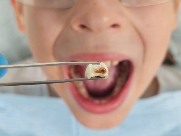 Best Emergency Dental Care for Broken or Chipped Teeth in Churchill, MT