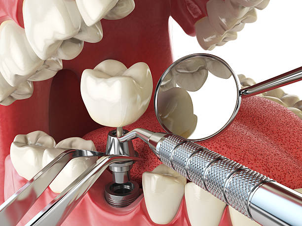 Best Emergency Treatment for Dental Infections or Abscesses in Churchill, MT